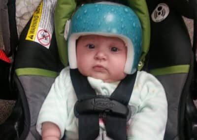 Helmet Therapy For Baby