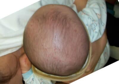 Before Baby Helmet Treatment