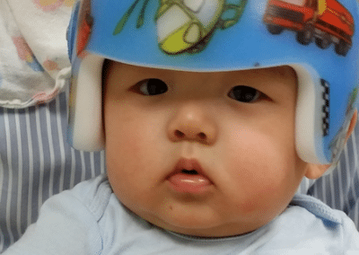 Helmet Treatment For Baby