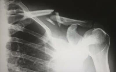 How Pectus Carinatum and Scoliosis Affect Bones and Bracing Solutions