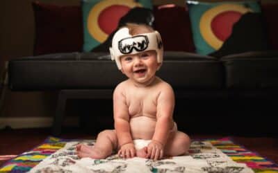 What Is Plagiocephaly And How Can an Orthotist Treat It?