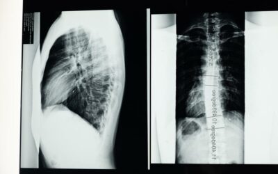 Boston Brace: Mechanism, Indications, Cost and Complications